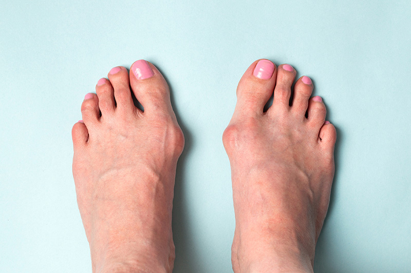 woman-with-bunions